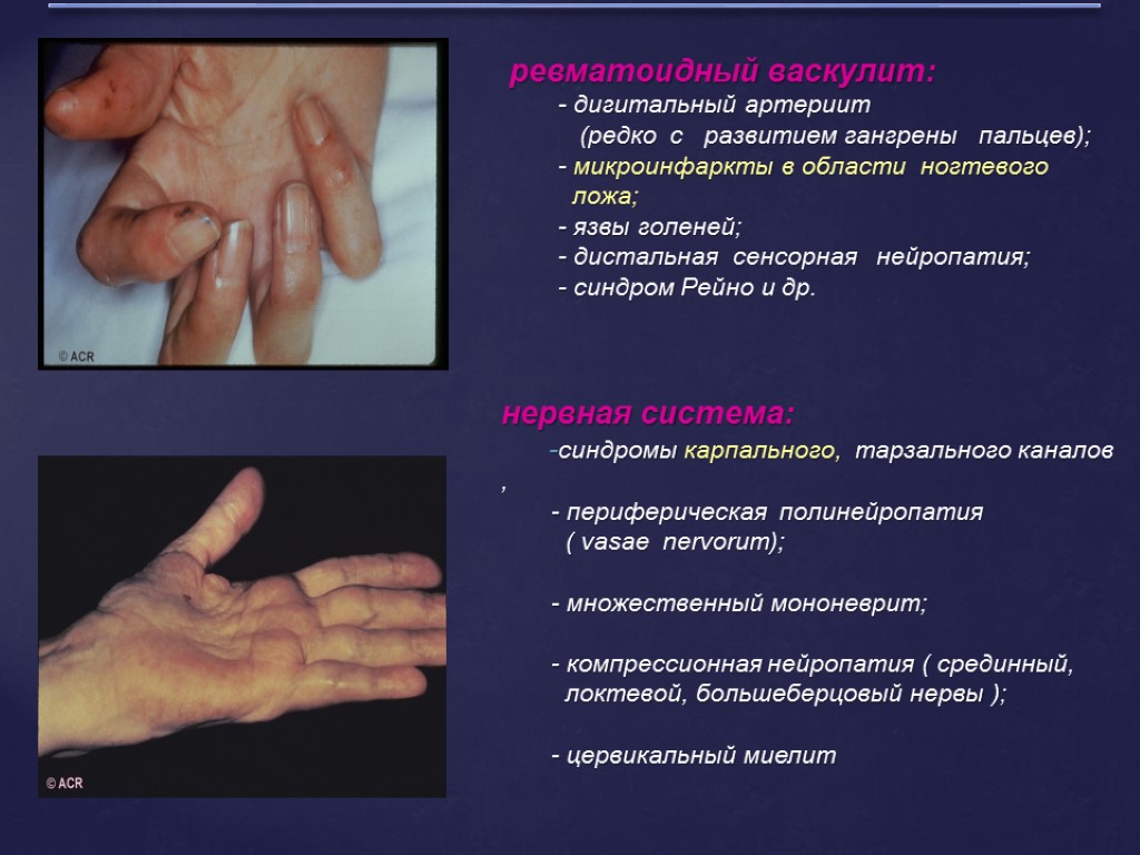 ревматоидный васкулит: - дигитальный артериит (редко с развитием гангрены пальцев); - микроинфаркты в области